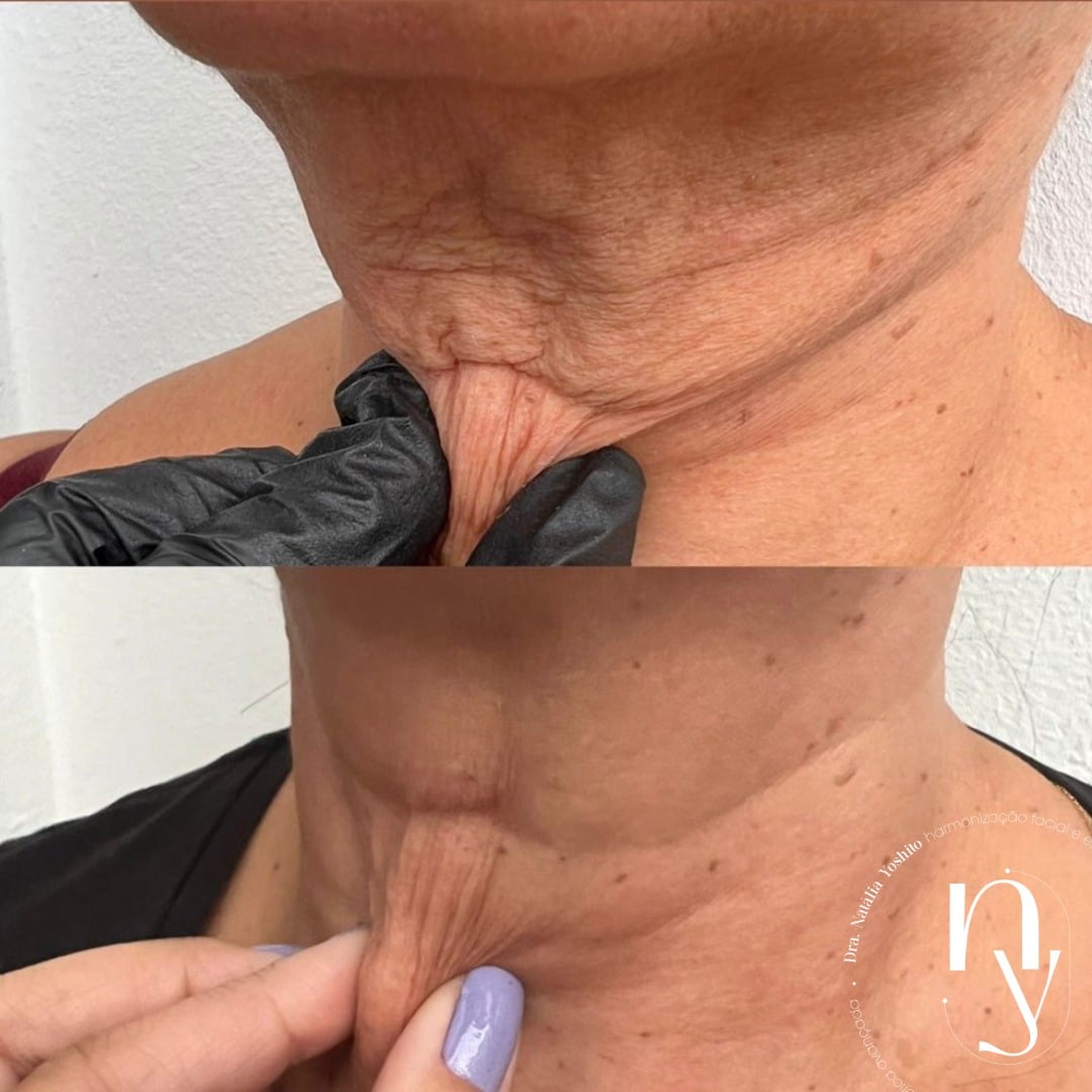 bio estimulador de colageno